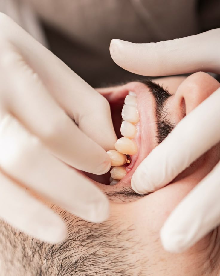 Colocação de coroa sobre implante dentário durante procedimento