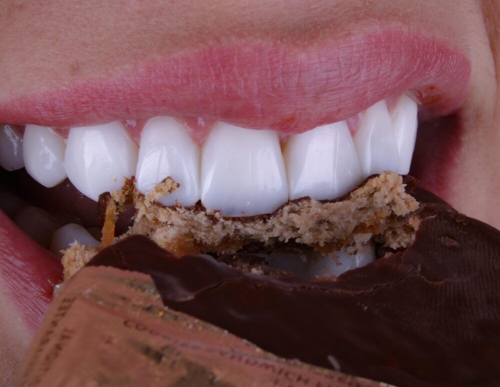 Sorriso com facetas em resina — caso da Dra. Delci