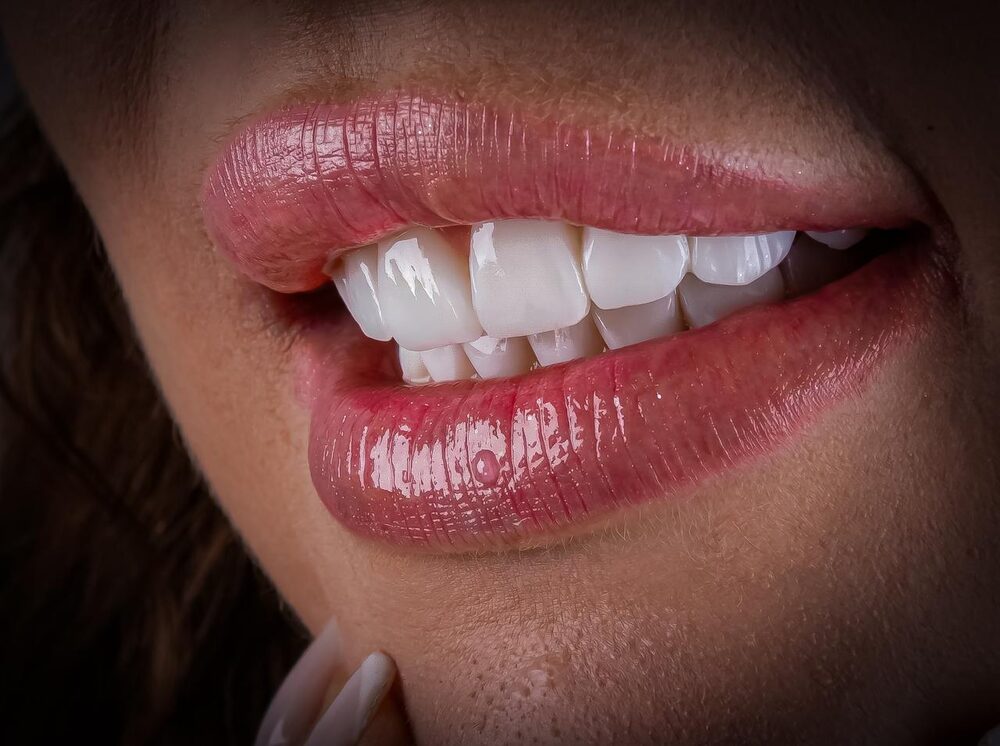 Detalhe de lábios e dentes com facetas em resina — caso da Dra. Delci